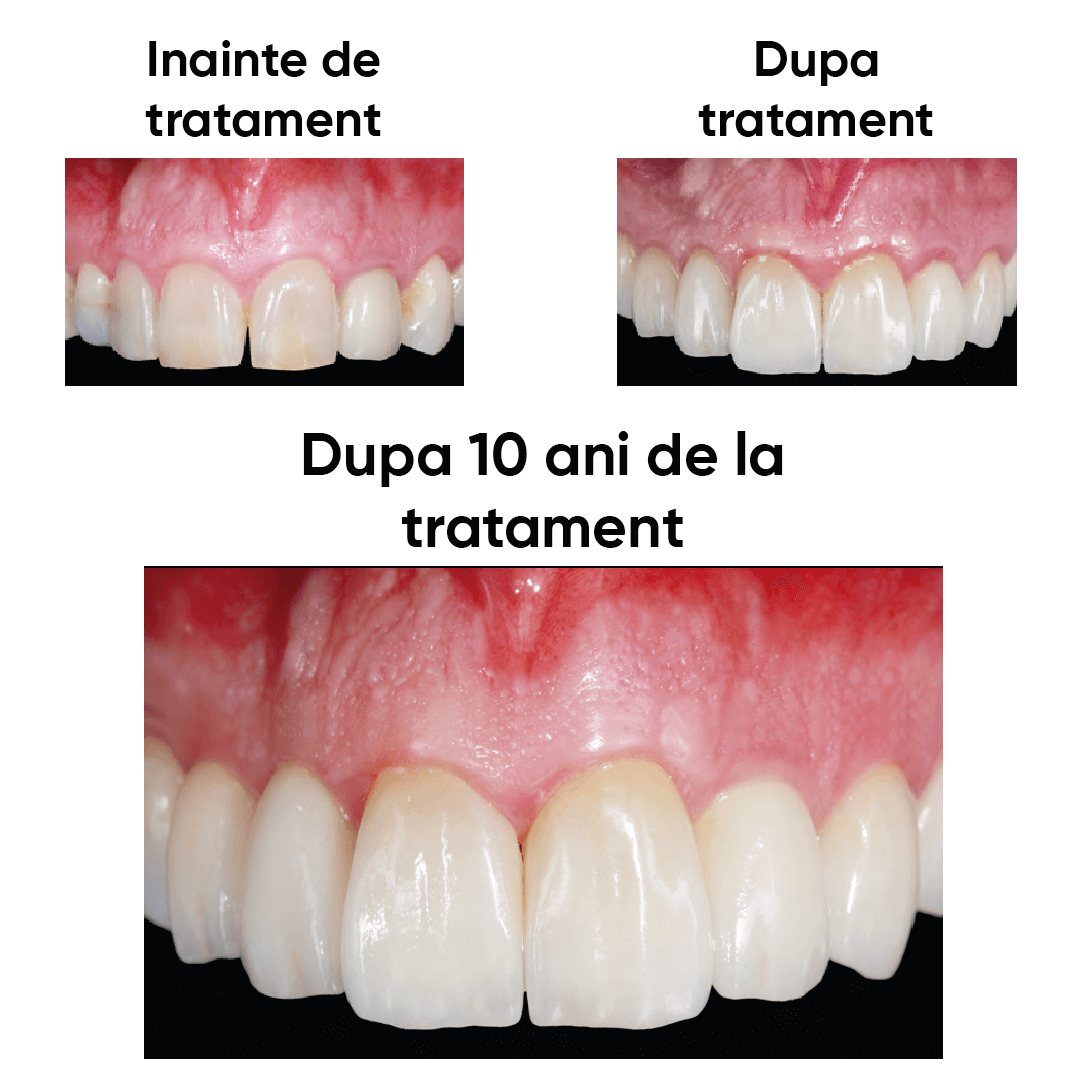 durata de rezistenta a unui tratament realizat cu ceramica presata ips e.max ceram press