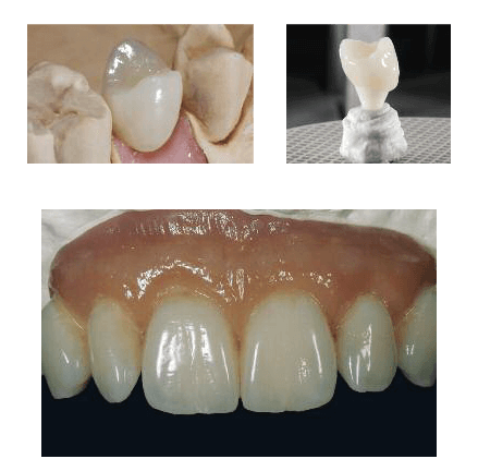 restaurari cu ceramica ips e.max ceram zirpress